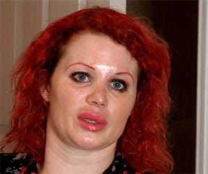 plastic surgery goes wrong, women left with weired nose job