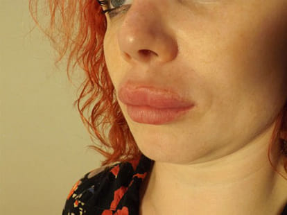 plastic surgery goes wrong, women left with weired nose job