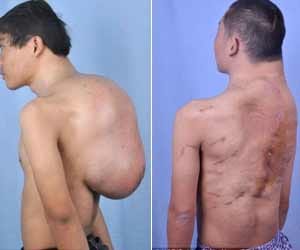 chinese man has tumour
