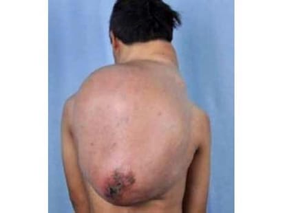 chinese man has tumour
