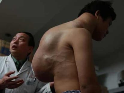chinese man has tumour