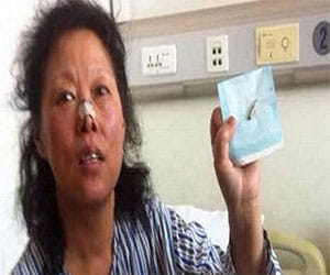 women survives 48 years with bullet inside skull 