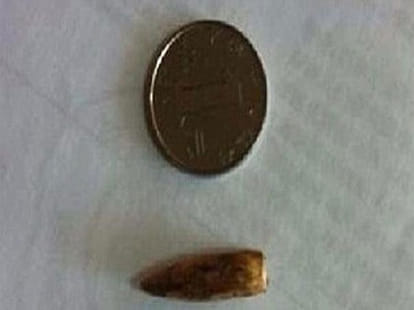 women survives 48 years with bullet inside skull 
