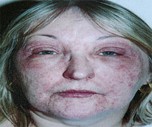 lady who breaks out with rashes when enters her bedroom!