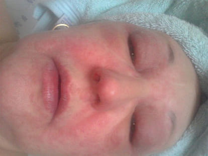 lady who breaks out with rashes when enters her bedroom!