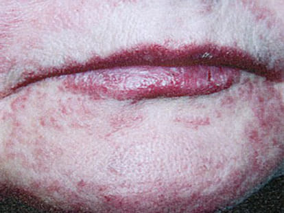 lady who breaks out with rashes when enters her bedroom!