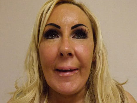 lip surgery went wrong