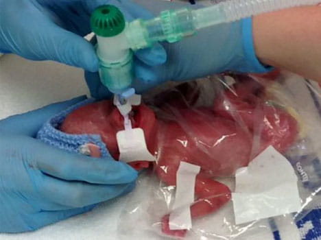 newborn's life saved by a sandwich bag