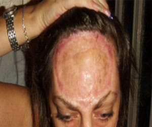 women with no forehead