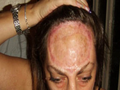 women with no forehead
