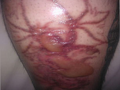 man undergoes tatoo removal surgery to start once again