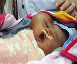 baby with two heads