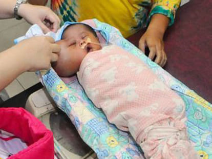 baby with two heads