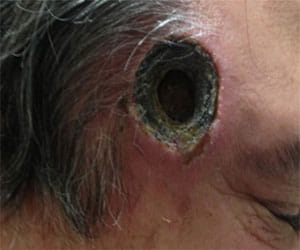 ointment made a hole in man's temple