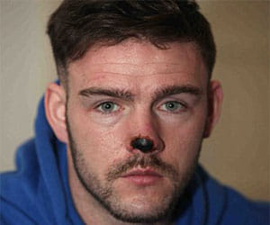 man whose nose was bitten off in a street brawl
