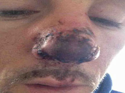 man whose nose was bitten off in a street brawl