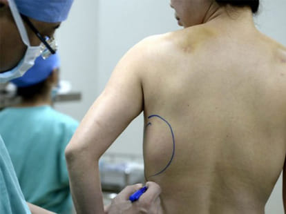 breast surgery went wrong