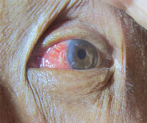 wrong operation of eyes in mathura