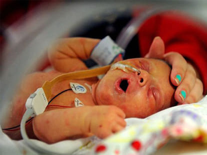 baby born with just half a heart