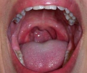 Fungus than the risk of mouth cancer