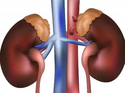 tea may be the cause of kidney stone 