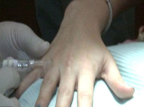 cosmetic hands lift