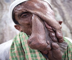 man suffering from tumour on face