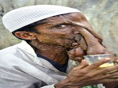 man suffering from tumour on face