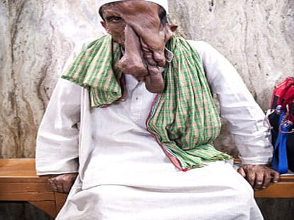 man suffering from tumour on face