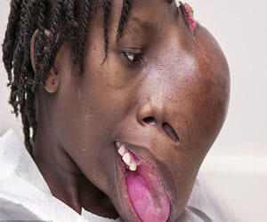 girl with a tumour on her face