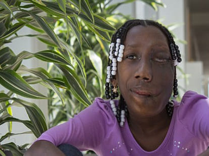 girl with a tumour on her face