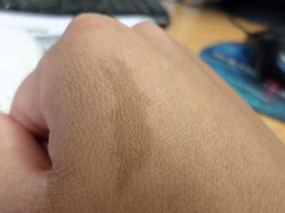 dark pimple can be a sign of skin cancer