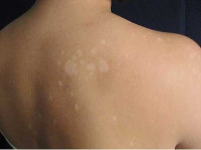 dark pimple can be a sign of skin cancer