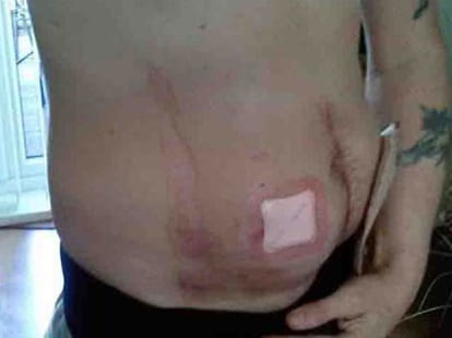 man's stomach cathches fire
