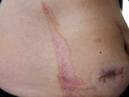 man's stomach cathches fire