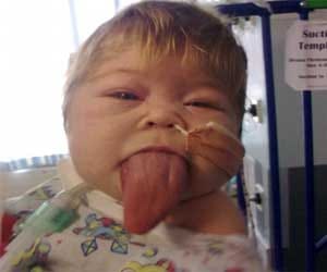 baby woth growing tongue