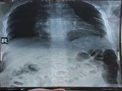 boy found with coins, blades and poly bags in stomach