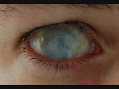 blind_chhatisgarh_ocular miosis