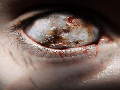 Eye Camp in Amritsar - 60 Patients Lost Vision after Surgery 
