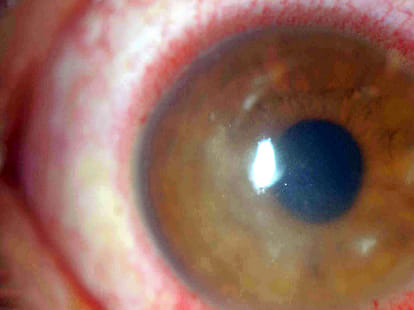 blind_chhatisgarh_ocular miosis