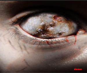 blind_chhatisgarh_ocular miosis