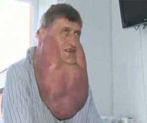 man with seven kilos tumour under chin