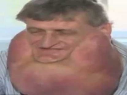 man with seven kilos tumour under chin