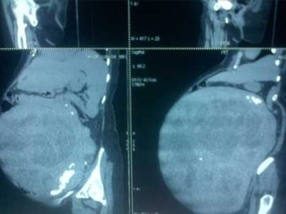 woman with 15 kilos of tumour in uteras