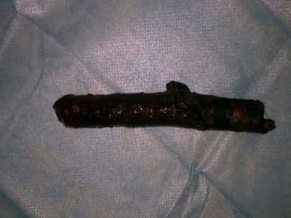 old lady walked 7 miles to reach hospital with tree trunk in neck 
