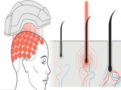 a helmet that can cure baldness
