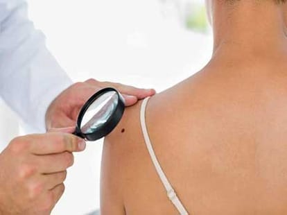 mole can be a sign of breast cancer in women