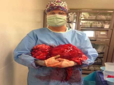 women with 21.5 kilos of tumour