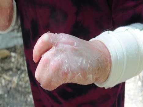 girl whose fingers fuse together