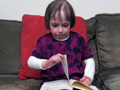 girl whose fingers fuse together